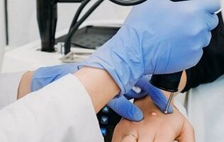 τρόποι αφαίρεσης των κονδυλωμάτων