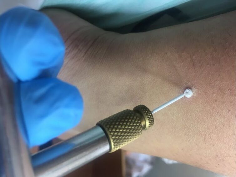 τρόποι αφαίρεσης των κονδυλωμάτων