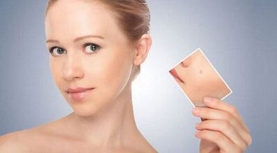 ανασκόπηση αποτελεσματικών θεραπειών για κονδυλώματα και θηλώματα